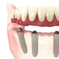 Understanding the 4 at the Dentist: What Do Those Numbers Really Mean?